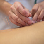 Treatment by acupuncture