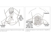 Commentary on Banxia Xie Xin Decoction and Hypertonicity of the Abdominal Muscles
