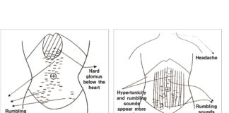 Commentary on Banxia Xie Xin Decoction and Hypertonicity of the Abdominal Muscles