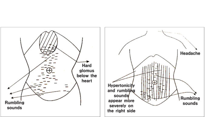 Commentary on Banxia Xie Xin Decoction and Hypertonicity of the Abdominal Muscles
