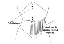 The Dynamics of Shang Han Lun ⑬ Particulars-Part 3 Pressure Pain on Left Below the Umbilicus (臍左下按壓痛)