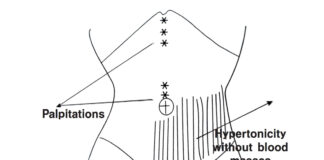 The Dynamics of Shang Han Lun ⑬ Particulars-Part 3 Pressure Pain on Left Below the Umbilicus (臍左下按壓痛)