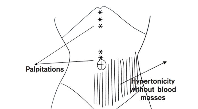 The Dynamics of Shang Han Lun ⑬ Particulars-Part 3 Pressure Pain on Left Below the Umbilicus (臍左下按壓痛)