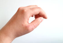 Healthy Digestive Tract Can Relieve Symptoms from Atopic Dermatitis