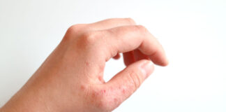 Healthy Digestive Tract Can Relieve Symptoms from Atopic Dermatitis