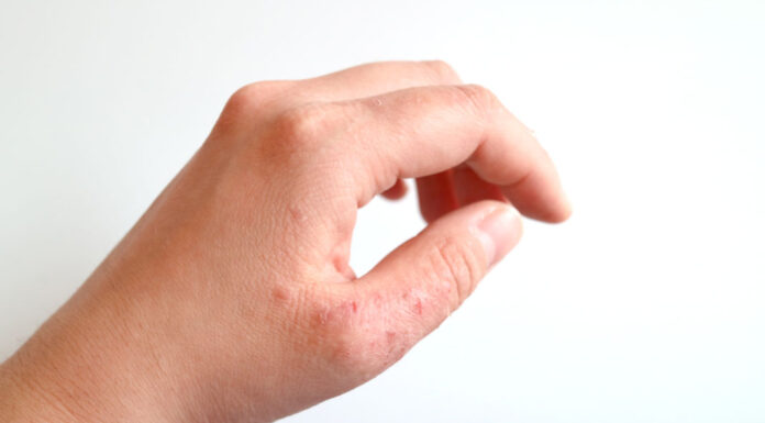 Healthy Digestive Tract Can Relieve Symptoms from Atopic Dermatitis