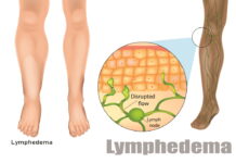 Lymphedema with Sasang Herbal Medicine