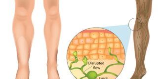 Lymphedema with Sasang Herbal Medicine