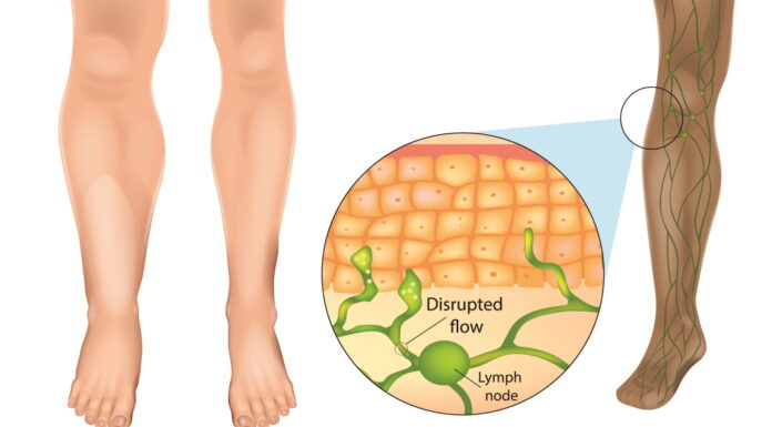 Lymphedema with Sasang Herbal Medicine