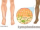 Lymphedema with Sasang Herbal Medicine