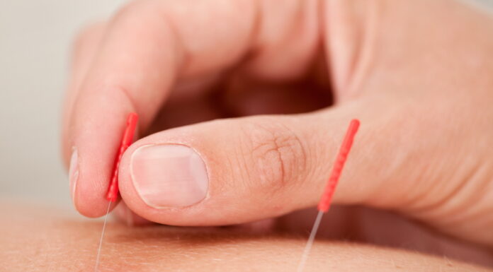 Acupuncture Actually Worked to Reduce cLBP