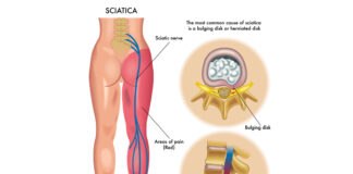 Two different sciatica treatments depend on causes