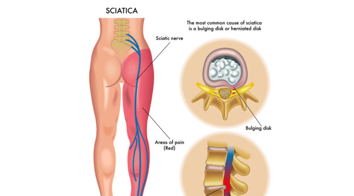 Two different sciatica treatments depend on causes