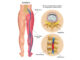 Two different sciatica treatments depend on causes