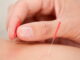 Clinical Application of Saam acupuncture (Four Points Acupuncture) (2)