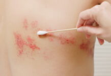 Acupuncture Promotes The Immediate Healing Of Shingles