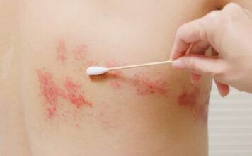 Acupuncture Promotes The Immediate Healing Of Shingles