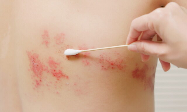 Acupuncture Promotes The Immediate Healing Of Shingles