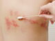 Acupuncture Promotes The Immediate Healing Of Shingles