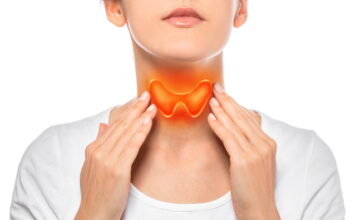 Treating Hyperthyroidism with Herbs