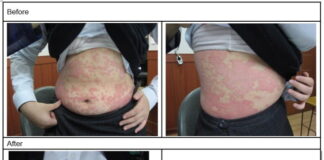 Yi Yi Ren (薏苡仁) Is Applied To Treat Various Skin Related Symptoms