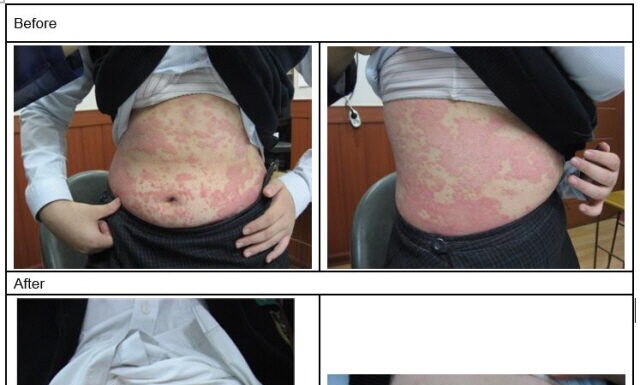 Yi Yi Ren (薏苡仁) Is Applied To Treat Various Skin Related Symptoms