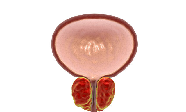 Hua Shi Treats Various Urinary Problems With Inflammation