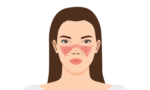 Constitutional Acupuncture; Case Study on Lupus Erythematosus and Migraine