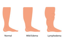 Clue Herbs That Help Finding Formulas for Treating Fluid Balance: