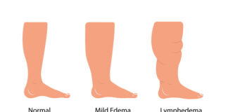 Clue Herbs That Help Finding Formulas for Treating Fluid Balance: