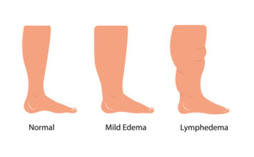 Clue Herbs That Help Finding Formulas for Treating Fluid Balance: