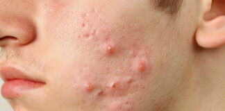 Acne and Cyst Herbal Medicine for Soyangin