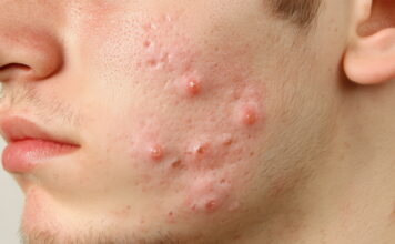 Acne and Cyst Herbal Medicine for Soyangin