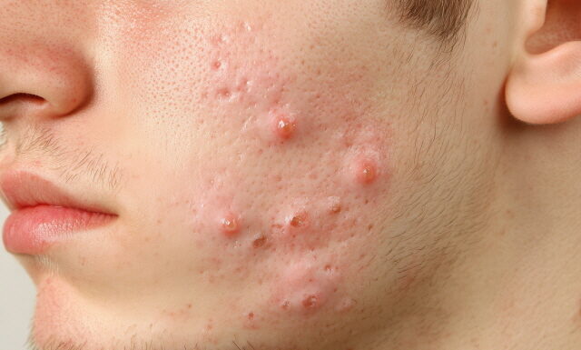 Acne and Cyst Herbal Medicine for Soyangin