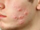Acne and Cyst Herbal Medicine for Soyangin