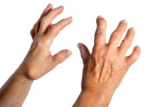 Case Study: Finger Tingling Resolved by Nourishing Yin