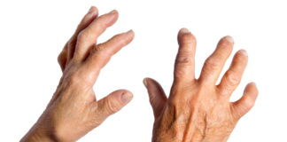 Case Study: Finger Tingling Resolved by Nourishing Yin