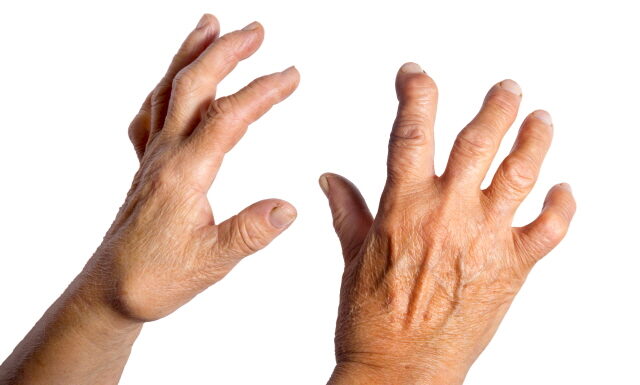 Case Study: Finger Tingling Resolved by Nourishing Yin