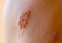 Shingle? Acupuncture is working on its Pain