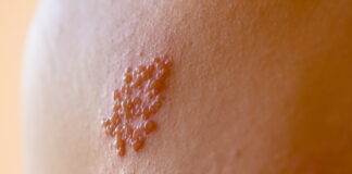 Shingle? Acupuncture is working on its Pain