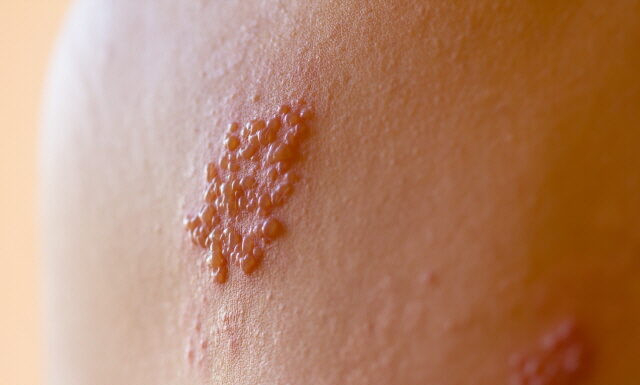 Shingle? Acupuncture is working on its Pain