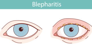 Bisoma Acupuncture Opens Door to Blepharitis Relief