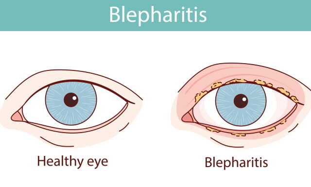 Bisoma Acupuncture Opens Door to Blepharitis Relief
