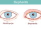 Bisoma Acupuncture Opens Door to Blepharitis Relief