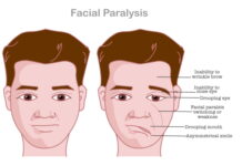 Wuyao-Shunqi-San in Treating Post-Stroke Aftereffects
