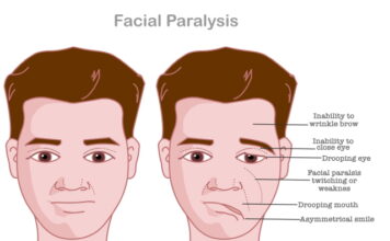 Wuyao-Shunqi-San in Treating Post-Stroke Aftereffects