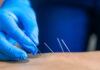 Dry Needling Legal in 40 States; Only 3 Still Prohibit It