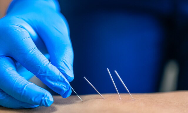 Dry Needling Legal in 40 States; Only 3 Still Prohibit It