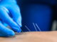 Dry Needling Legal in 40 States; Only 3 Still Prohibit It