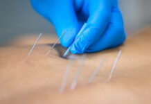 Physical Therapists’ Dry Needling Bill AB 2497 Defeated on California Assembly Floor